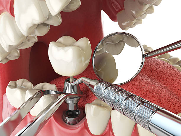 Best Emergency Dental Extractions in Holt, MI